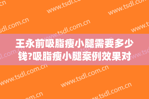王永前吸脂瘦小腿需要多少钱?吸脂瘦小腿案例效果对比图_中国医学科学院整形外科医院