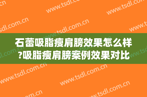 石蕾吸脂瘦肩膀效果怎么样?吸脂瘦肩膀案例效果对比图_中国医学科学院整形外科医院