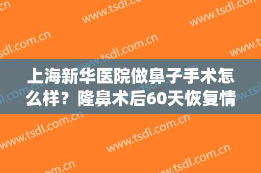 上海新华医院做鼻子手术怎么样？隆鼻术后60天恢复情况报告，附价格~(鼻整形术后恢复)
