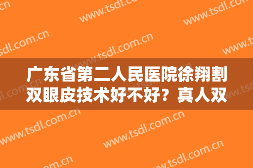 广东省第二人民医院徐翔割双眼皮技术好不好？真人双眼皮一个月的恢复历程
