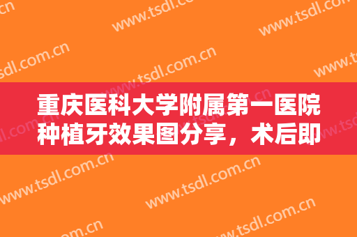 重庆医科大学附属第一医院种植牙效果图分享，术后即刻啃苹果不在话下！