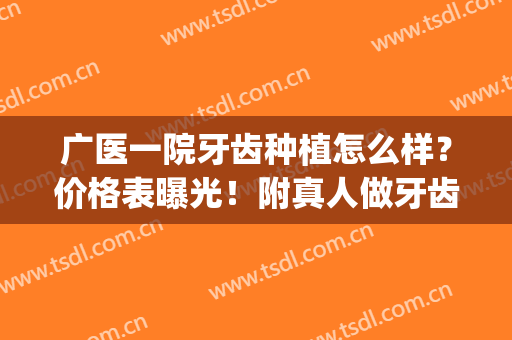 广医一院牙齿种植怎么样？价格表曝光！附真人做牙齿种植全过程！(广州广大口腔医院种植牙价格)