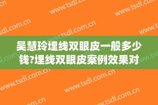吴慧玲埋线双眼皮一般多少钱?埋线双眼皮案例效果对比图_浙江大学医学院附属第一医院