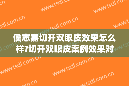 侯志嘉切开双眼皮效果怎么样?切开双眼皮案例效果对比图_首都医科大学附属北京同仁医院