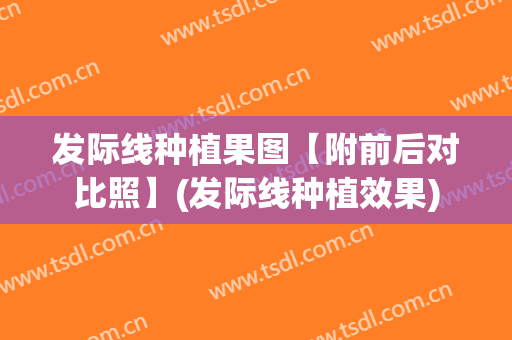 发际线种植果图【附前后对比照】(发际线种植效果)