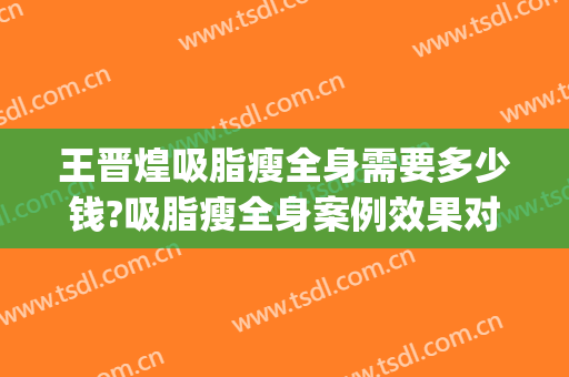 王晋煌吸脂瘦全身需要多少钱?吸脂瘦全身案例效果对比图_南方医科大学珠江医院