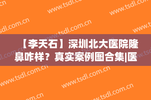【李天石】深圳北大医院隆鼻咋样？真实案例图合集|医生简历(北京大学深圳医院李天石价格)