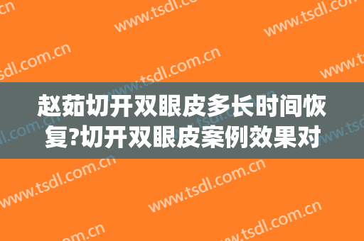 赵茹切开双眼皮多长时间恢复?切开双眼皮案例效果对比图_中国医学科学院北京协和医院