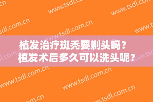 植发治疗斑秃要剃头吗？ 植发术后多久可以洗头呢？